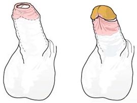 包皮包茎问题解析